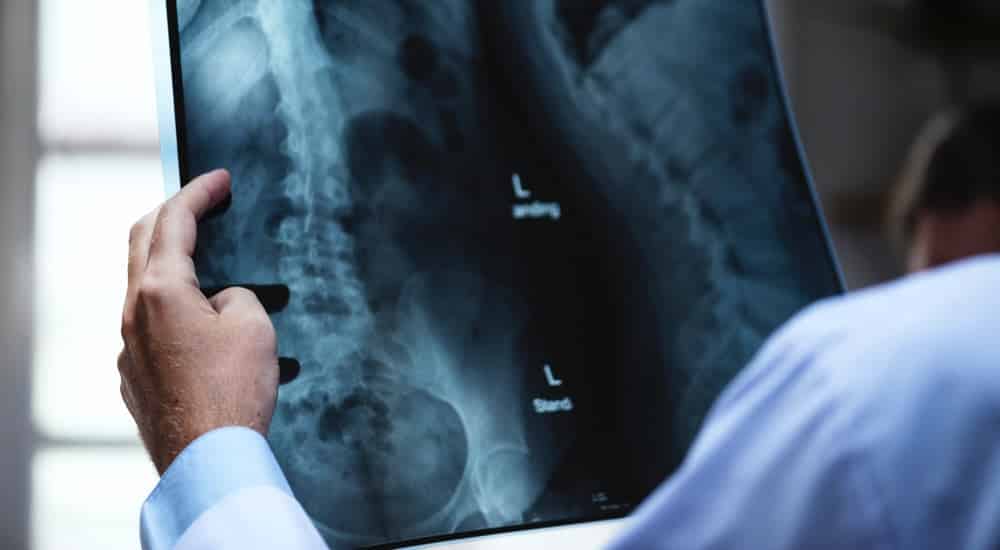 Milch gesund Osteoporose