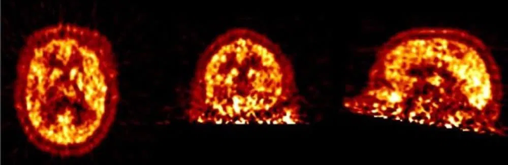 Kaffee gegen Alzheimer - PET Diagnostik