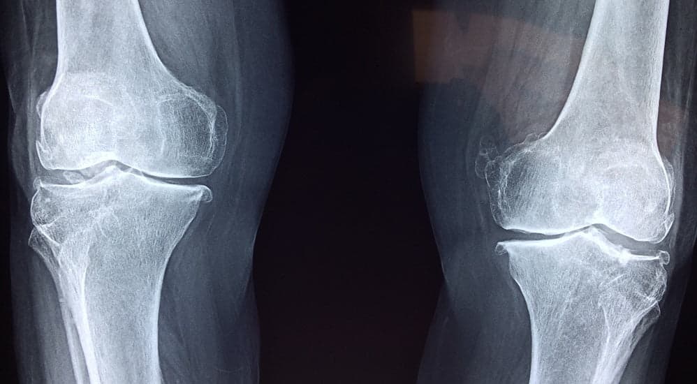 Calciummangel - Osteoporose